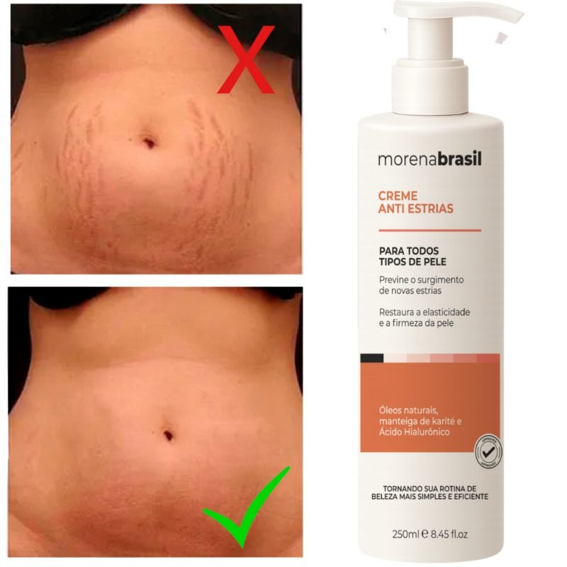 Creme Anti-Estrias - Diga Adeus às Estrias! Previne Novas Estrias Reforça a Elasticidade ...